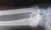 Новый рентгеновский аппарат получила поликлиника №17 на проспекте Металлистов 