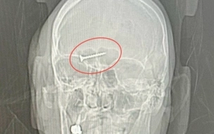 Петербургские врачи достали из головы пациента металлический саморез и резиновый шарик
