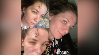 Актриса Анастасия Веденская показала, как выглядят её шрамы после драки в кафе в Петербурге