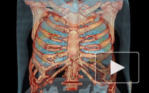 У бессимптомно болевших коронавирусом нашли поражения легких