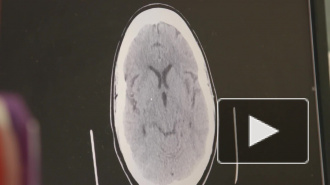 Врачи дали рекомендации по предупреждению инсульта