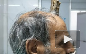В Индии у мужчины на голове вырос десятисантиметровый рог