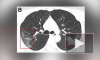 Китайские медики показали снимки легких, которые поражены коронавирусом
