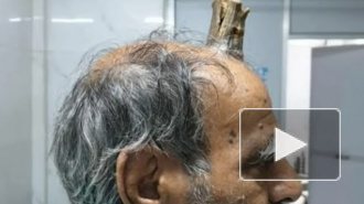 В Индии у мужчины на голове вырос десятисантиметровый рог