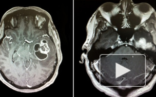 Что такое рак: первые признаки, симптомы, диагностика и лечение